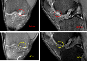 Γόνατο πριν & μετά την έκγχυση βλαστοκυττάρων Stem Cells